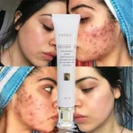 Crème Réparatrice FATAZEN 30g – Élimine les Cicatrices, Marques d’Acné et Vergetures, Soin Anti-Inflammatoire & Régénérant