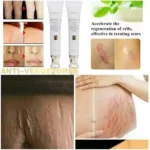 Crème Réparatrice FATAZEN 30g – Élimine les Cicatrices, Marques d’Acné et Vergetures, Soin Anti-Inflammatoire & Régénérant – Image 2